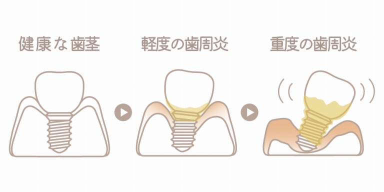 インプラント周囲炎になってしまった