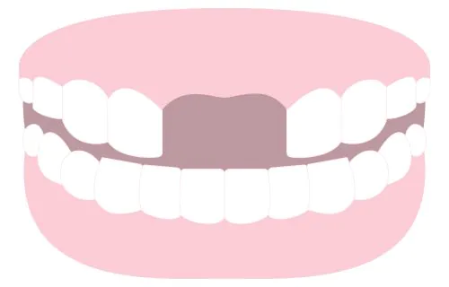 前歯のインプラント治療<