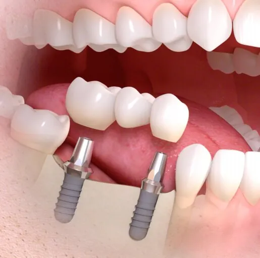 奥歯を含む複数の歯を失った場合の治療