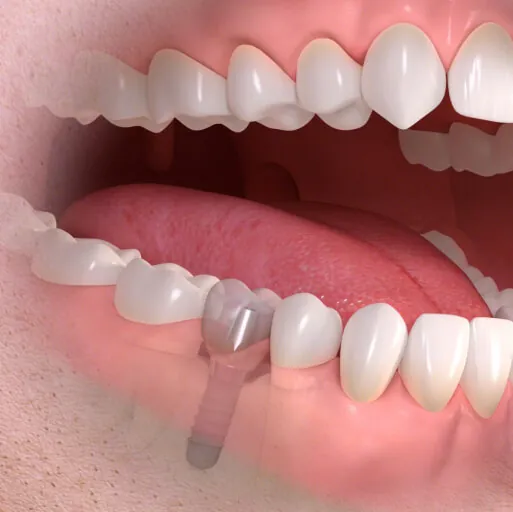 インプラント 最短当日で仮歯まで!１Ｄayインプラント治療も対応可能