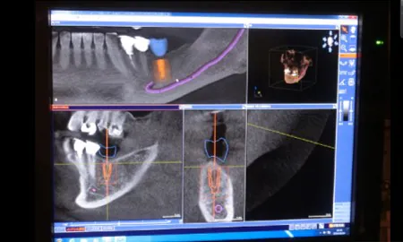 院内CTによる診断・設計及びサージガイドの使用