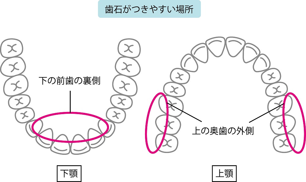 歯石除去