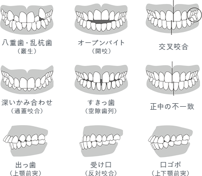 様々な不正咬合にも対応可能