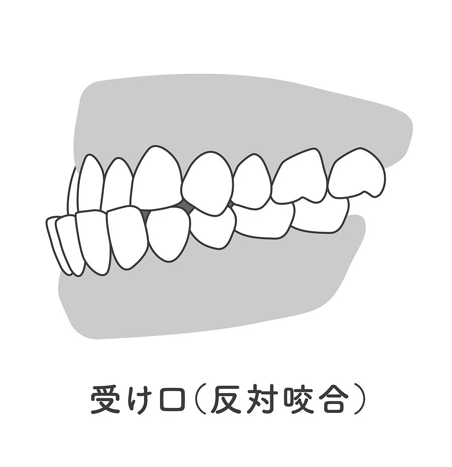 受け口（反対咬合、下顎前突）