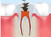 虫歯の除去