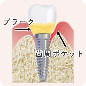 インプラント歯周炎には注意