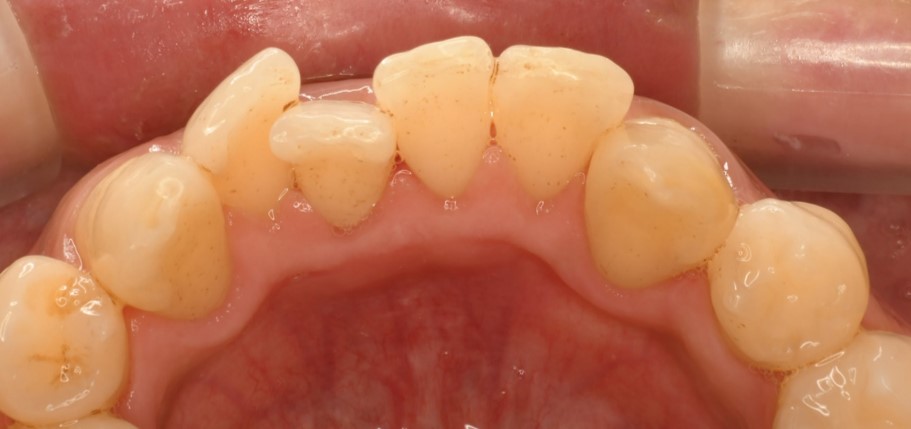 歯のクリーニング 症例